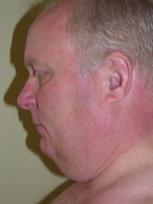 Facelift Before and After Pictures Washington, DC