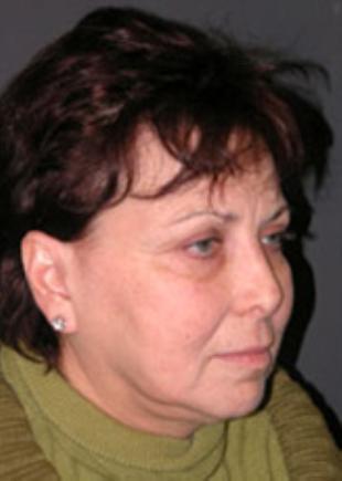 Facelift Before and After Pictures Washington, DC