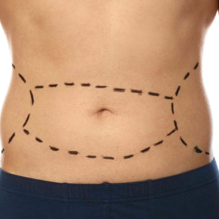 Tummy Tuck vs. Skin Tightening Surgery Pricing in Northern Virginia