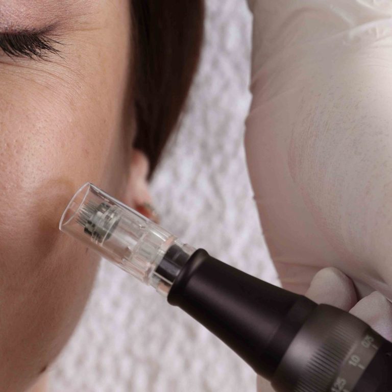 Microneedling Cost and Skin Rejuvenation Results in Northern Virginia