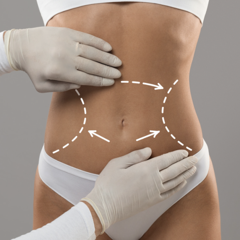Liposuction Cost in Springfield