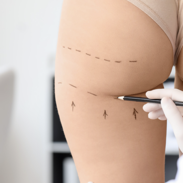 Best Liposuction Surgeon in Reston