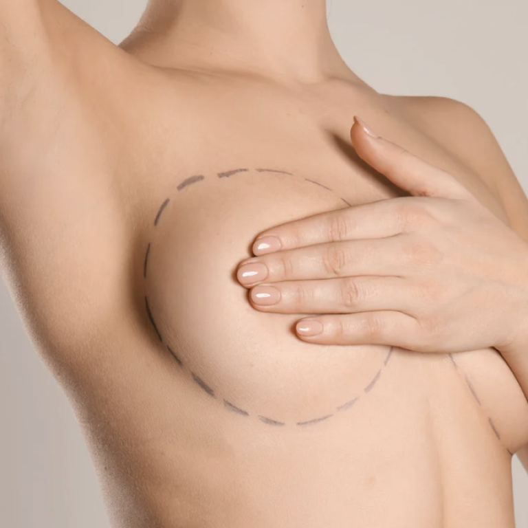 Fat Transfer to Breast