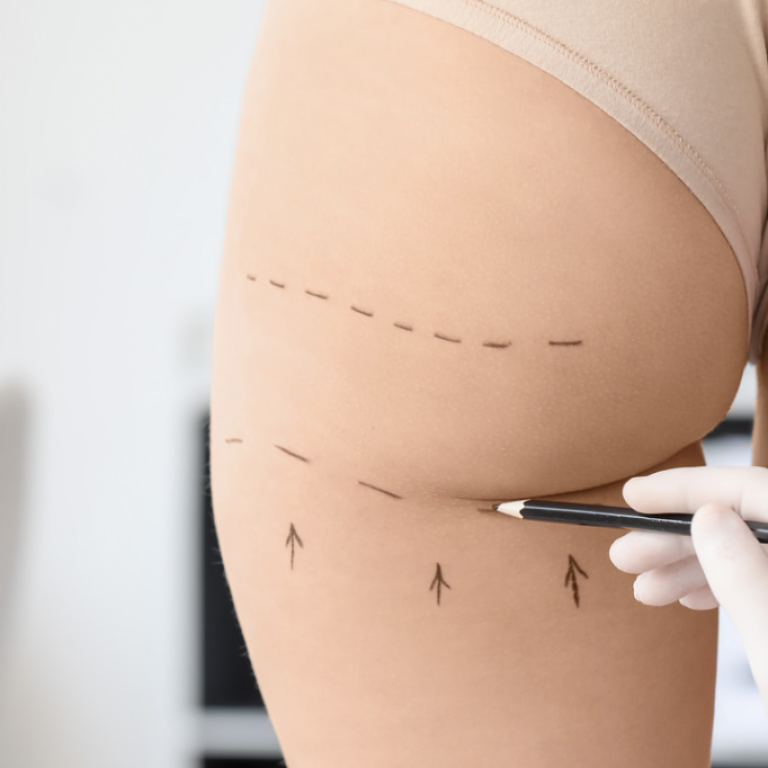 Best Liposuction Results