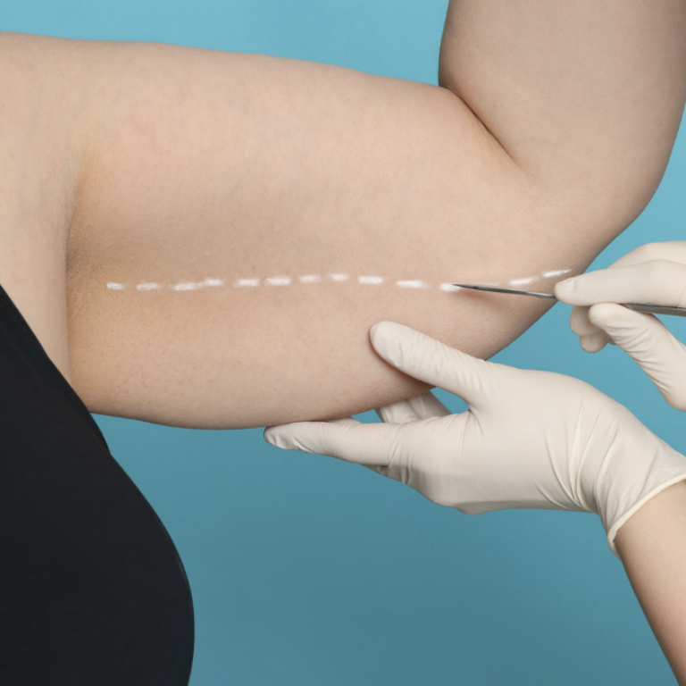 Liposuction Costs in Arlington