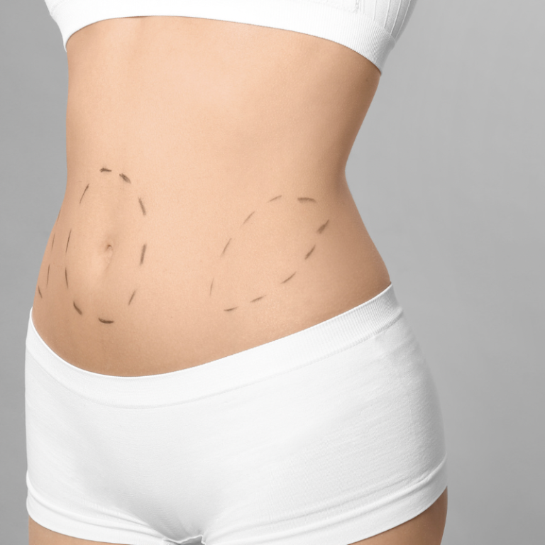 Affordable Liposuction in Arlington
