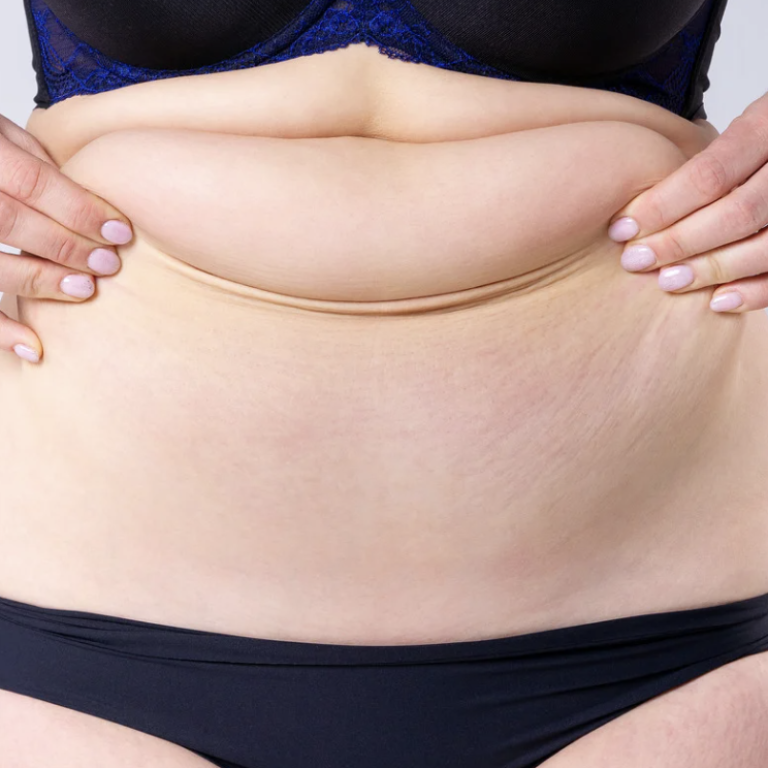 Mini vs Full Tummy Tuck Pricing in Reston