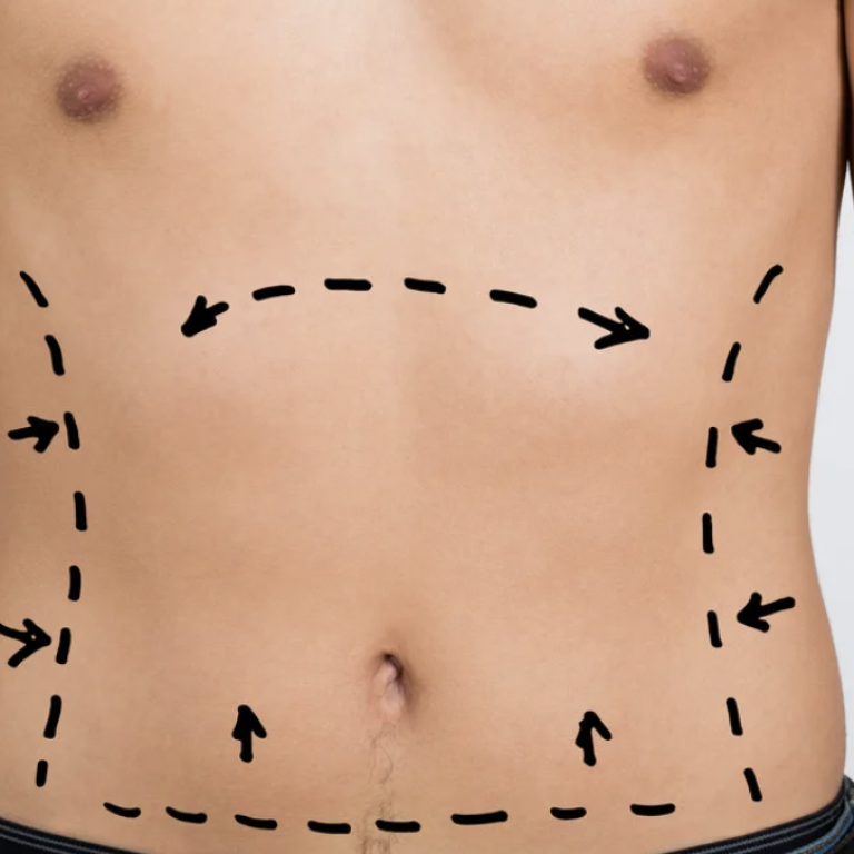 Liposuction Recovery and Cost Expectations in Reston Virginia