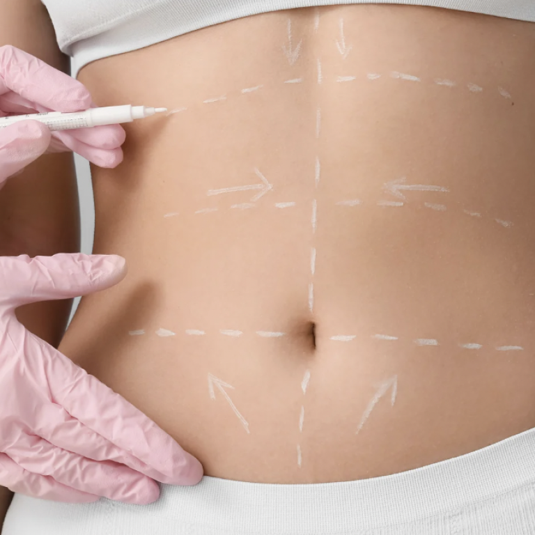 Tummy Tuck Surgery Cost Near McLean VA