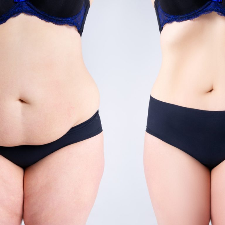 Best Tummy Tuck Cost in Chantilly