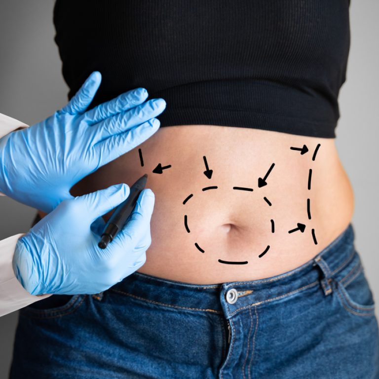 Best Liposuction Results in Ashburn Virginia