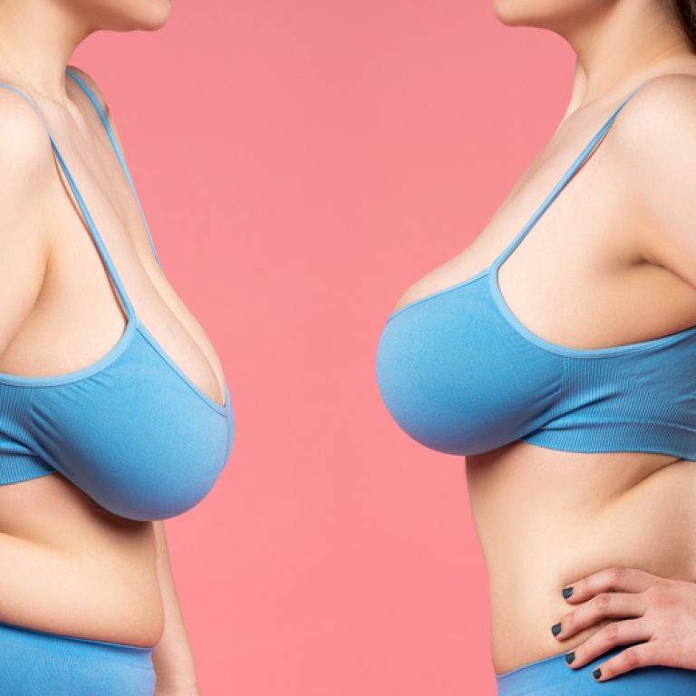 Breast Lift in McLean Virginia