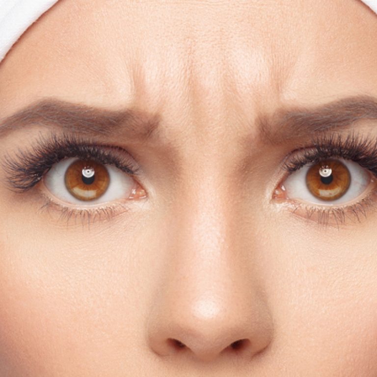 How Long Should Botox Last in Fairfax