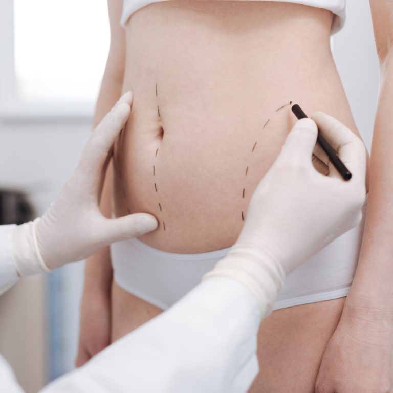 Best Liposuction Surgeon in Fairfax, Virginia